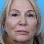 Facelift Before & After Patient #960