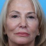 Facelift Before & After Patient #960