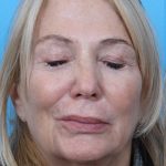Facelift Before & After Patient #960