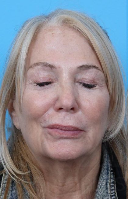 Facelift Before & After Patient #960