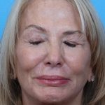 Facelift Before & After Patient #960