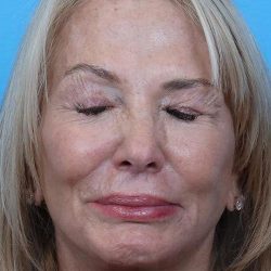 Facelift Before & After Patient #960