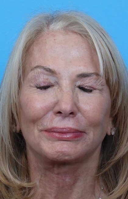 Facelift Before & After Patient #960
