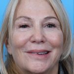 Facelift Before & After Patient #960