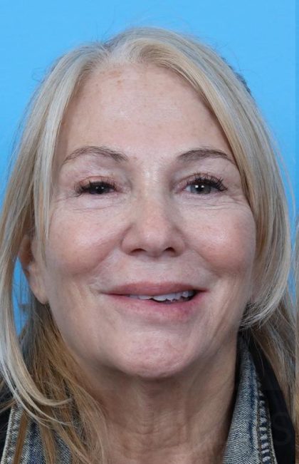 Facelift Before & After Patient #960