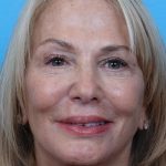 Facelift Before & After Patient #960