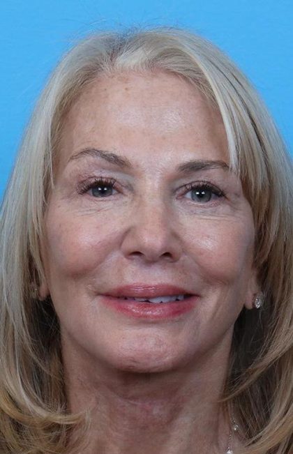 Facelift Before & After Patient #960