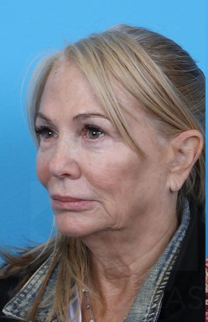 Facelift Before & After Patient #960