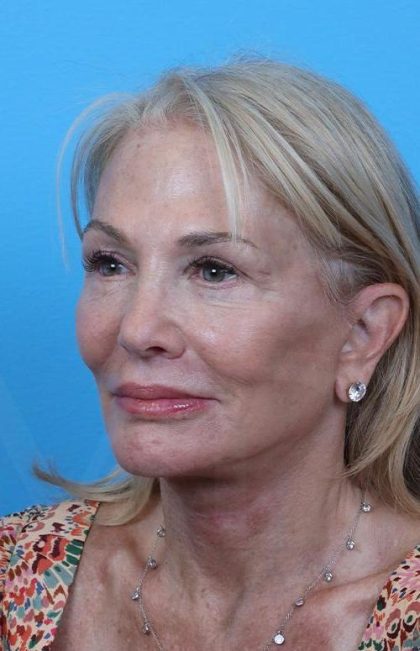 Facelift Before & After Patient #960