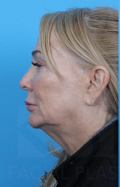 Facelift Before & After Patient #960