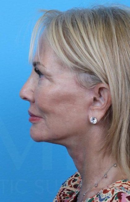 Facelift Before & After Patient #960