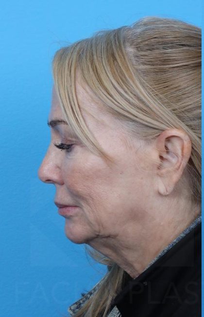 Facelift Before & After Patient #960
