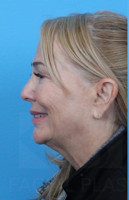 Facelift Before & After Patient #960