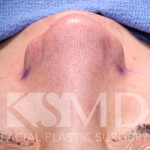 Revision Rhinoplasty Before & After Patient #961