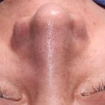 Revision Rhinoplasty Before & After Patient #961