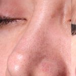 Revision Rhinoplasty Before & After Patient #961