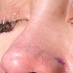 Revision Rhinoplasty Before & After Patient #961