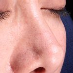 Revision Rhinoplasty Before & After Patient #961