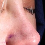 Revision Rhinoplasty Before & After Patient #961