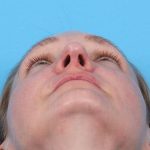 Revision Rhinoplasty Before & After Patient #962
