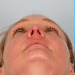 Revision Rhinoplasty Before & After Patient #962