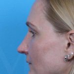 Revision Rhinoplasty Before & After Patient #962