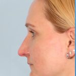 Revision Rhinoplasty Before & After Patient #962