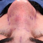 Revision Rhinoplasty Before & After Patient #963