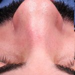 Revision Rhinoplasty Before & After Patient #963