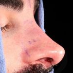 Revision Rhinoplasty Before & After Patient #963