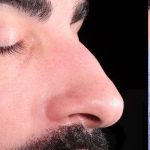 Revision Rhinoplasty Before & After Patient #963