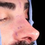 Revision Rhinoplasty Before & After Patient #963
