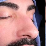 Revision Rhinoplasty Before & After Patient #963