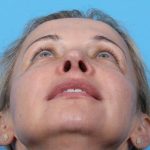 Rhinoplasty Before & After Patient #1010