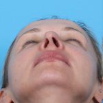 Rhinoplasty Before & After Patient #1010