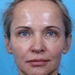 Rhinoplasty Before & After Patient #1010