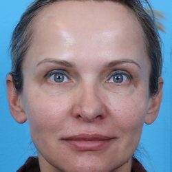 Rhinoplasty Before & After Patient #1010