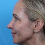 Rhinoplasty Before & After Patient #1010