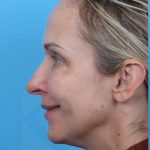 Rhinoplasty Before & After Patient #1010