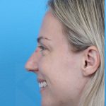 Rhinoplasty Before & After Patient #1011