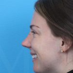 Rhinoplasty Before & After Patient #1011