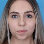 Rhinoplasty Before & After Patient #1012