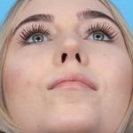 Rhinoplasty Before & After Patient #1012