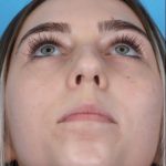Rhinoplasty Before & After Patient #1012