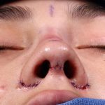 Rhinoplasty Before & After Patient #1013