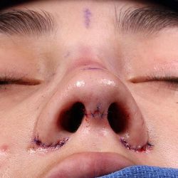Rhinoplasty Before & After Patient #1013