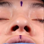 Rhinoplasty Before & After Patient #1013