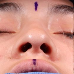 Rhinoplasty Before & After Patient #1013