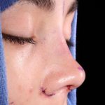 Rhinoplasty Before & After Patient #1013