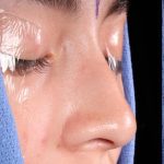 Rhinoplasty Before & After Patient #1013